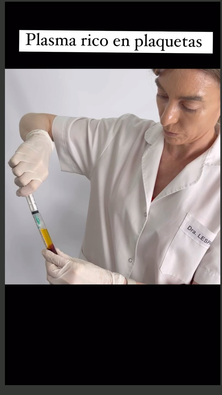 La Dra. Lespada, con guantes, carga plasma rico en plaquetas en una jeringa